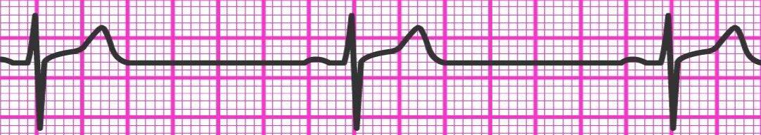 Électrocardiogramme